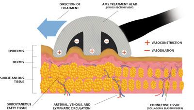 Vacuum massage physically manipulates the tissues to reduce the 